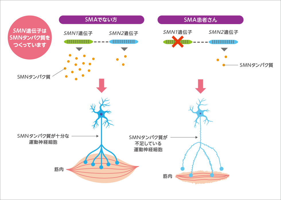 SMAでない方とSMA患者さんのSMN遺伝子と運動神経細胞（イメージ図）