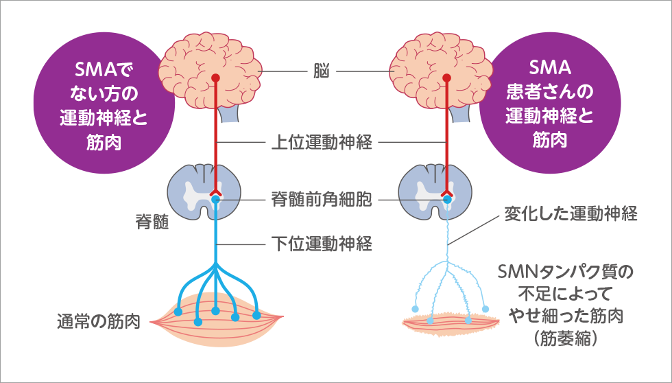 SMAでない方とSMA患者さんの運動神経細胞と筋肉